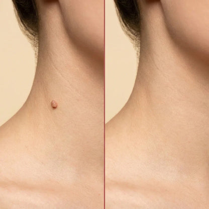 Cpviat™️ ClearTag Microneedle Skin Tag Patch