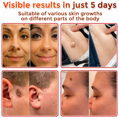 Cpviat™️ ClearTag Microneedle Skin Tag Patch